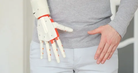 Patient is testing his new robotic prosthetic hand on the first time. Vídeo Stock 106221910