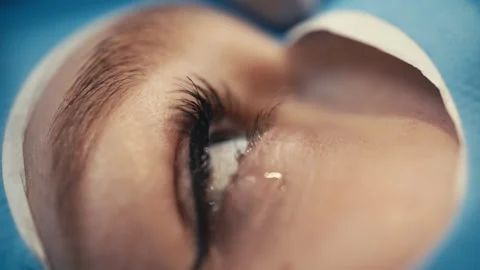 Patient undergoing ophthalmic surgery with close-up views of the eye, showcasing Stock Footage 337288286