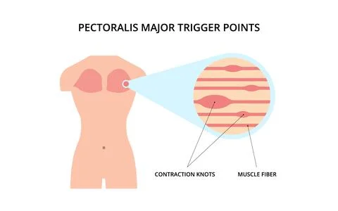 Pectoralis muscle trigger point Illustrazione stock