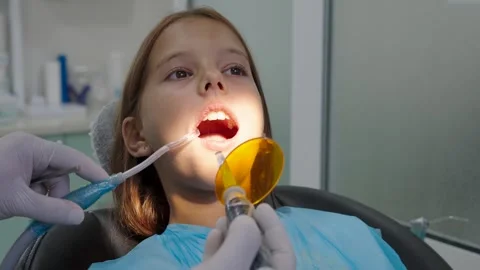 Pediatric dentist using UV curing light lamp on tooth filling for young girl. Vidéo 340630584