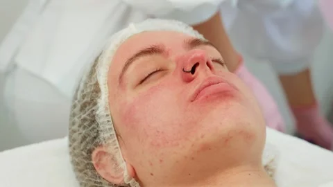 Peeling procedure with enzyme mask applied during cosmetology therapy. Gloved Stock Footage 312038192