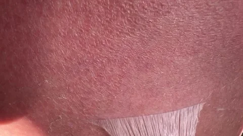 Peeling skin after sunburn, red burnt human skin, burns, new skin Stock Footage 317289366