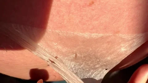 Peeling skin after sunburn, red burnt human skin, burns, new skin Stock Footage 317976459