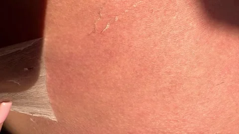 Peeling skin after sunburn, red burnt human skin, burns, new skin Stock Footage 317976782