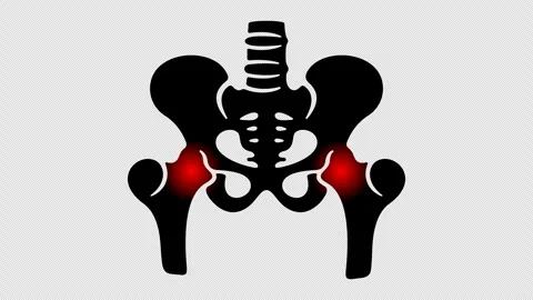 Pelvic bones or hip bone, hip inflammation, orthopedic, graphic animation Vidéo 304175248