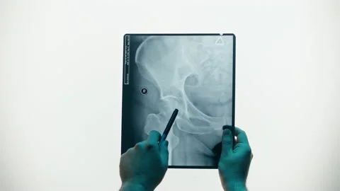 Pelvic hip x-ray close-up. Magnetic Resonance Image of human leg. Doctor Stock Footage 169198695