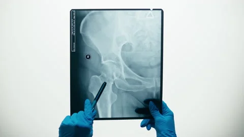 Pelvic hip x-ray close-up. Magnetic Resonance Image of human leg. Doctor Vídeo Stock 169199084