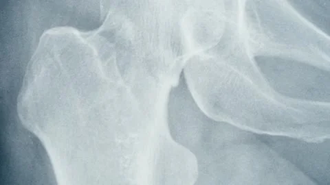 Pelvic hip x-ray close-up. Magnetic Resonance Image of human leg. Doctor Stock Footage 170586356