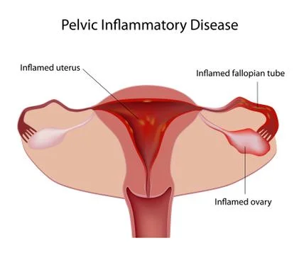 Pelvic inflammatory disease Stock Illustration