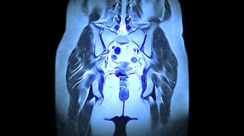Pelvis And Hips Video stock 34436781