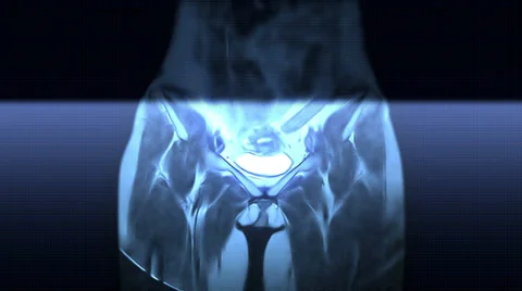 Pelvis And Hips Video stock 34436878