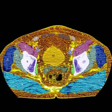  Pelvis, scan Axial section. 1.Rectus abdominis muscle. 2.Inguinal canal a... Stock Photos