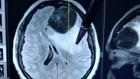 A pen points at the screen with MRI scan of the head.  Stock Footage 302374579