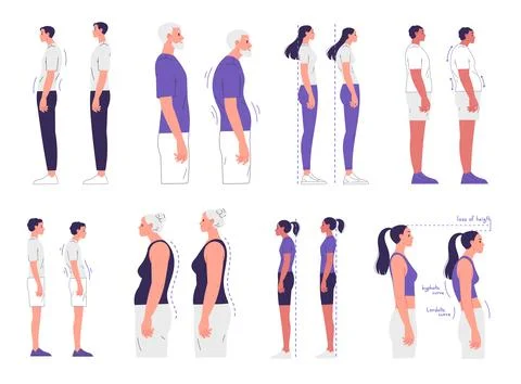 People with correct and incorrect posture. Scoliosis, curvature of the spine Stock Illustration
