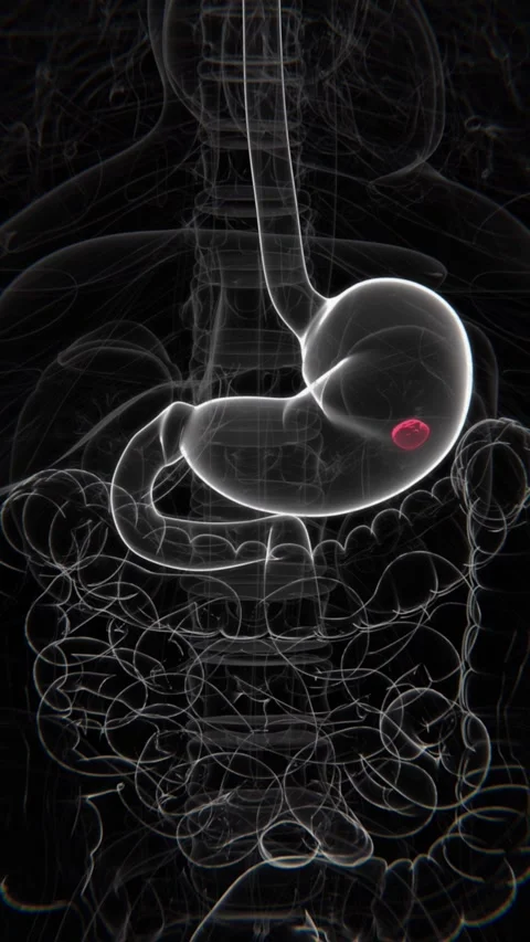 Peptic Ulcer Indication Video in HQ | Stomach Ulcers in Vertical HD Video Stock Footage 301304579