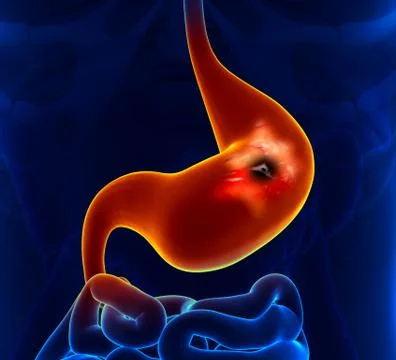 Peptic Ulcer - Stomach problem Stock-Illustration