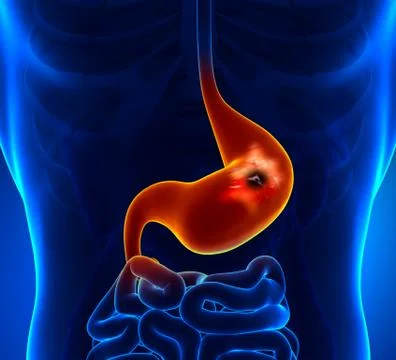 Peptic Ulcer - Stomach problem Stock-Illustration