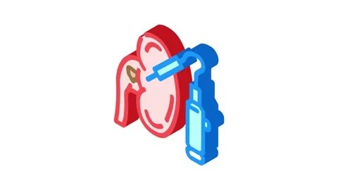 Percutaneous nephrolithotomy surgery isometric icon animation Stock Footage 327282999