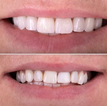 Perfect smile before and after whitening Implants crowns. Dental restoration Stock Photos