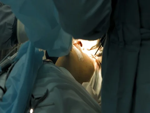 Performing surgery in operation room Video stock 81378557