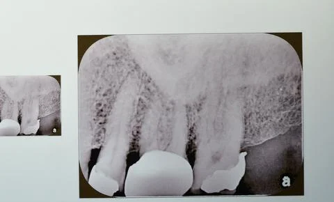 Periapical x-ray for upper 5,6 and 7 showing class II restoration in the 5 .. Stock Photos