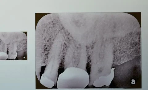 Periapical x-ray for upper 5,6 and 7 showing class II restoration in the 5 .. Stock Photos