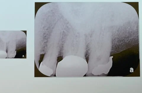 Periapical x-ray for upper 5,6 and 7 showing class II restoration in the 5 .. Stock Photos