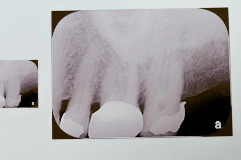 Periapical x-ray for upper 5,6 and 7 showing class II restoration in the 5 .. Stock Photos