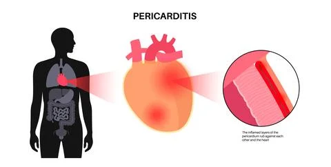 Pericarditis heart disease Illustrazione stock