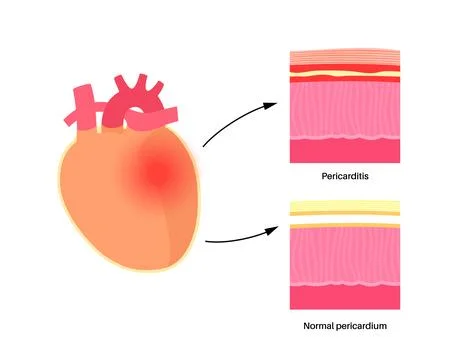 Pericarditis heart disease Stock Illustration
