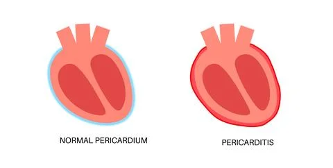 Pericarditis heart disease Stock Illustration