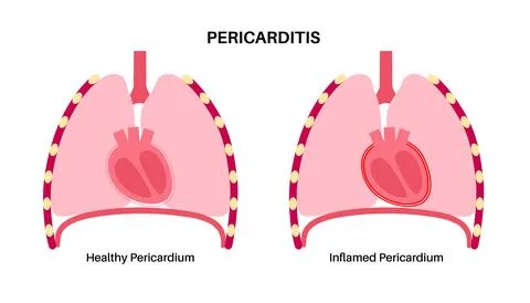Pericarditis heart disease Stock Illustration