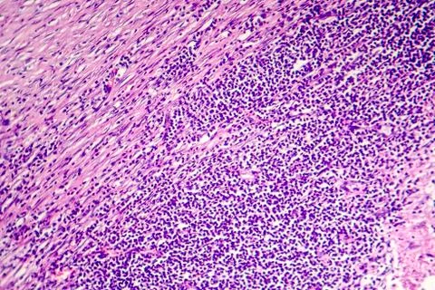Pericarditis, light micrograph, photo under microscope Stock Photos