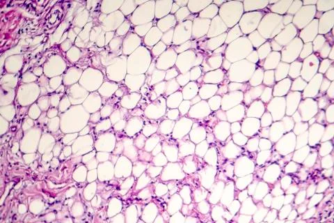 Pericarditis, light micrograph, photo under microscope Stock Photos