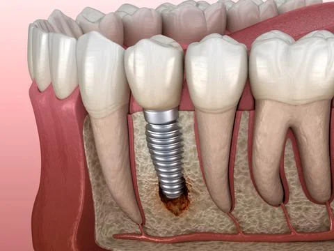 Periimplantitis with visible bone damage. Medically accurate 3D illustration Stock Illustration