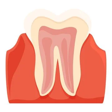 Periodontitis affecting human tooth and causing gum inflammation Stock Illustration