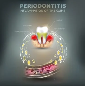Periodontitis complications poster Stock Illustration