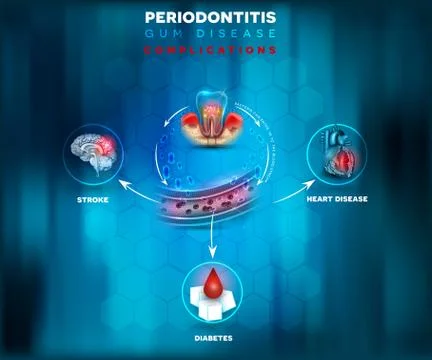 Periodontitis complications poster Stock Illustration