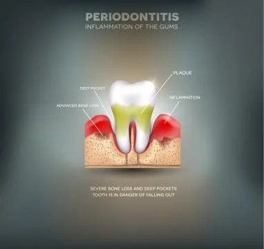 Periodontitis Stock Illustration