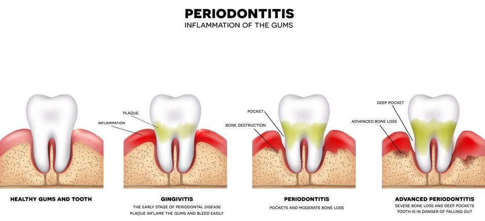 Periodontitis Stock Illustration