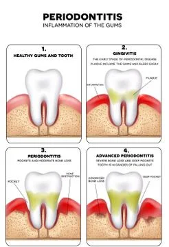 Periodontitis イラスト素材
