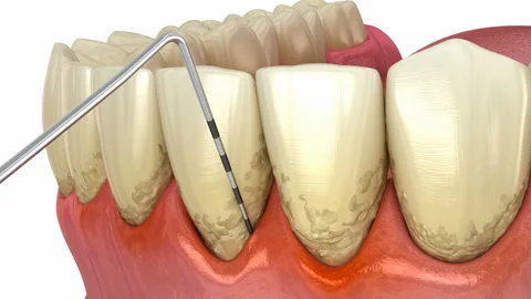 Periodontitis testing, gum recession process. Medically accurate 3D animation 库存影片 129309071