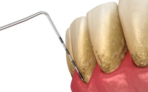 Periodontitis testing, gum recession process. Medically accurate Illustrazione stock