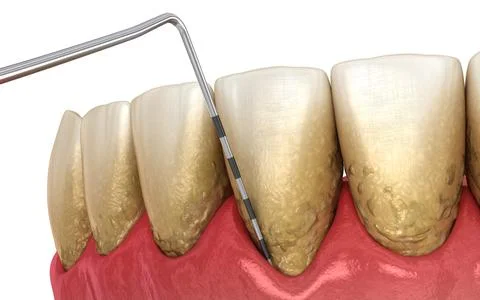 Periodontitis testing, gum recession process. Stock-Illustration