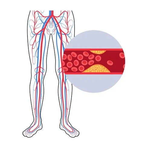 Peripheral artery disease Stock Illustration