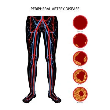 Peripheral artery disease Stock Illustration