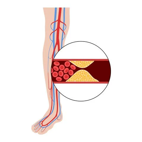 Peripheral artery disease Stock Illustration