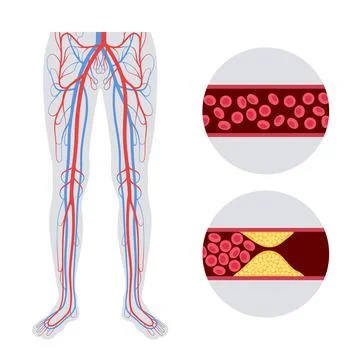 Peripheral artery disease Stock Illustration