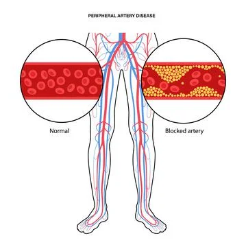 Peripheral artery disease Illustrazione stock