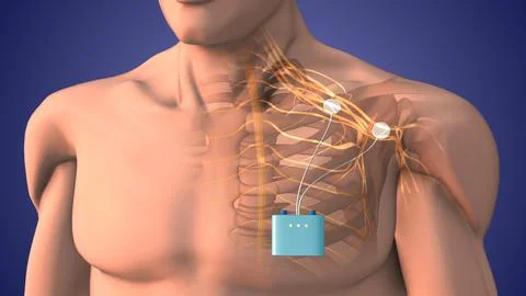 Peripheral nerve stimulation therapy in shoulder area Stock Illustration